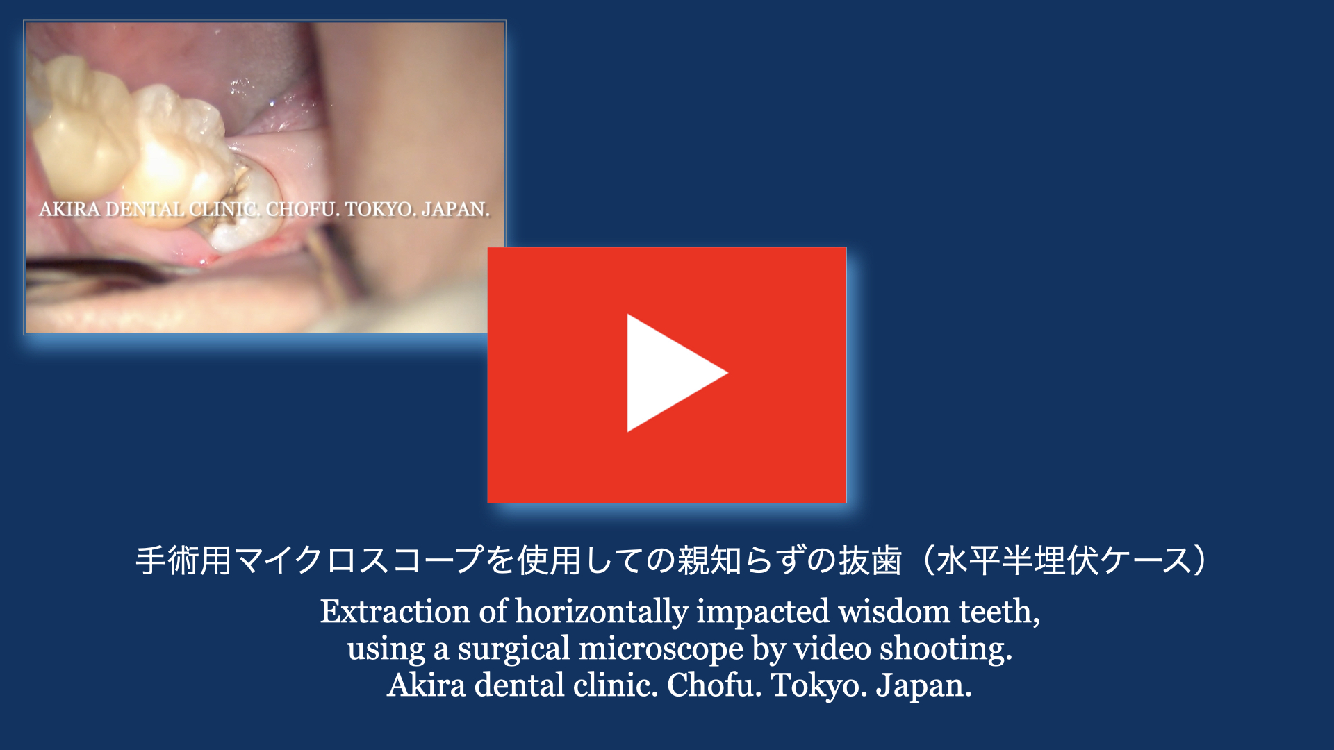 患者様の声 : 手術用マイクロスコープを使用しての親知らずの抜歯